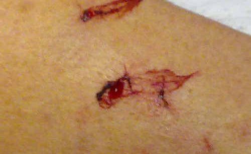 Rebecca Beale’s forearm and hand, showing bites. Rebecca Beale’s forearm and hand, showing bites.